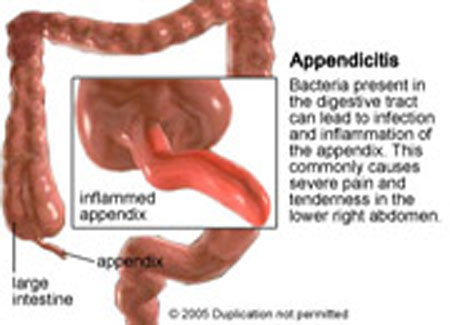 appendicitis
