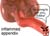 appendicitis-lrg