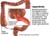 appendicitis